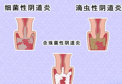 陰道分泌物香蕉爱视频APP剖析什麽是細菌性陰道炎