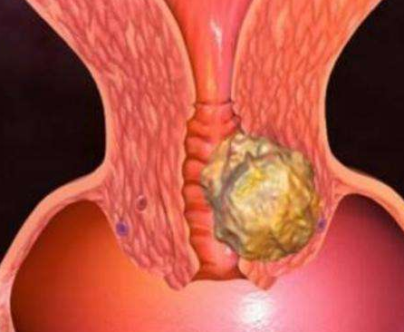 陰道分泌物香蕉爱视频APP廠家分析陰道分泌物多的原因