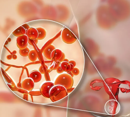 【全自動白帶香蕉成人A片视频】廠家山東香蕉网视频在线观看提醒陰道炎反反複複的4個誤區