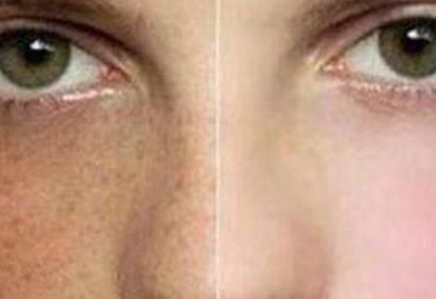 為什麽患婦科病的女性臉上更容易長斑