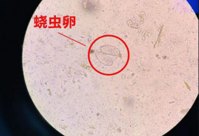 陰道分泌物香蕉爱视频APP警惕外陰繞蟲病易在兒童身上出現