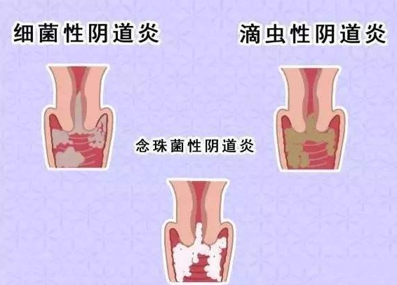 全自動陰道分泌物香蕉爱视频APP廠家提醒您還在拖延嗎，還在等陰道炎自愈嗎？